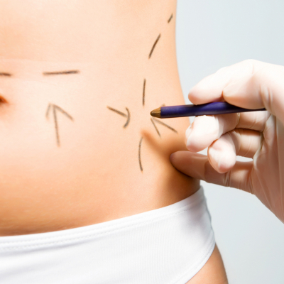 Liposuzione, ecco cosa c'e' da sapere