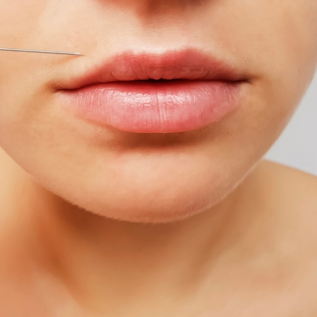 Lip beautification con i filler: piccole correzioni per labbra naturali