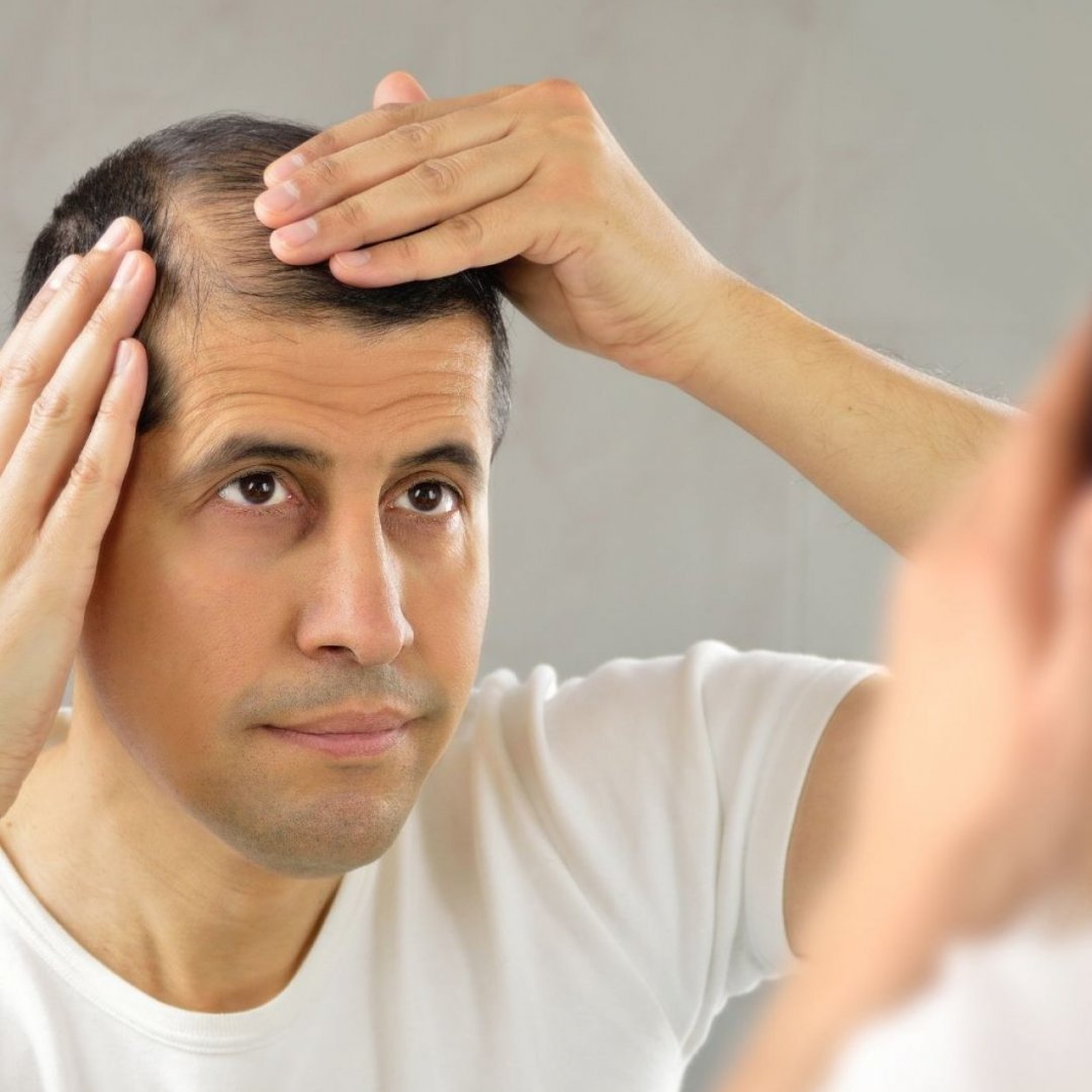 Stress e alopecia, cosa fare?