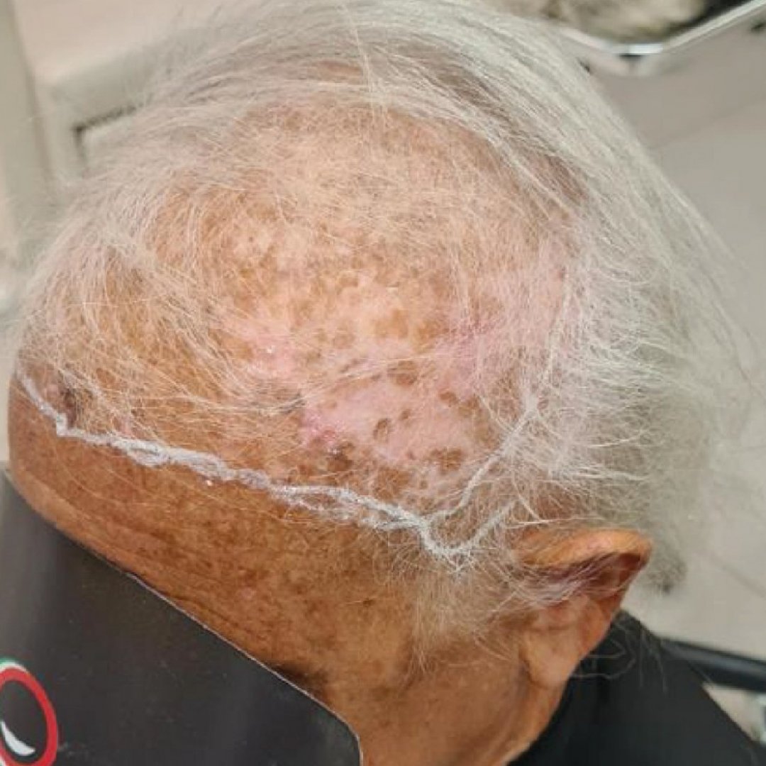SOS diradamento, alopecia o calvizie? La soluzione è già in Ticino