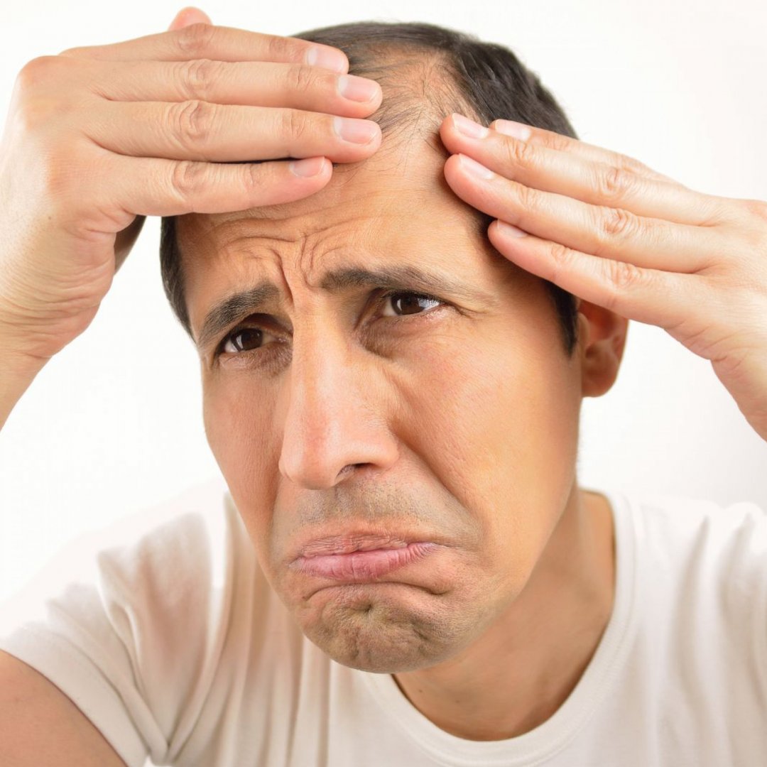 Quando la perdita dei capelli ci manda fuori di testa